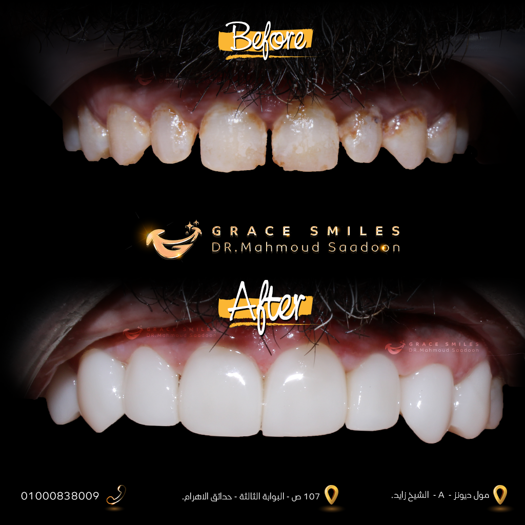 patients teeth before and after