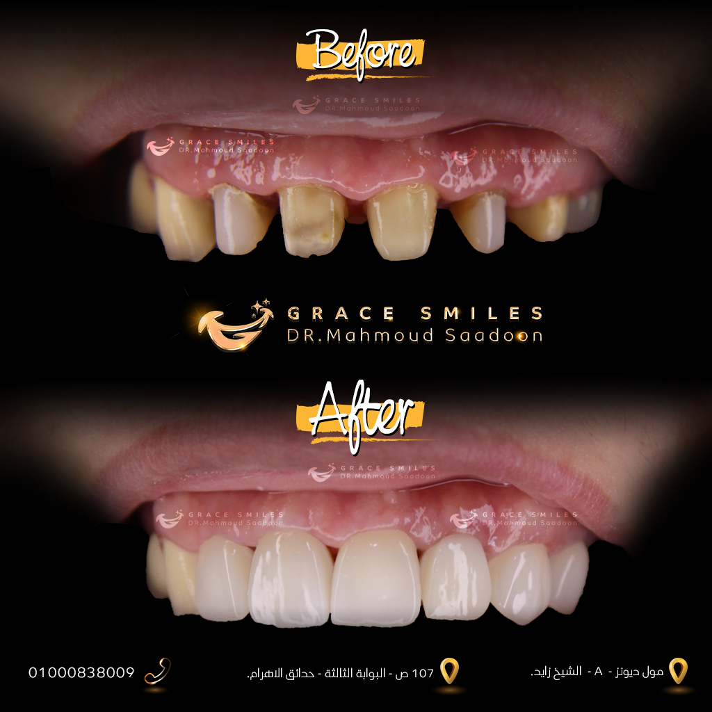 patients teeth before and after