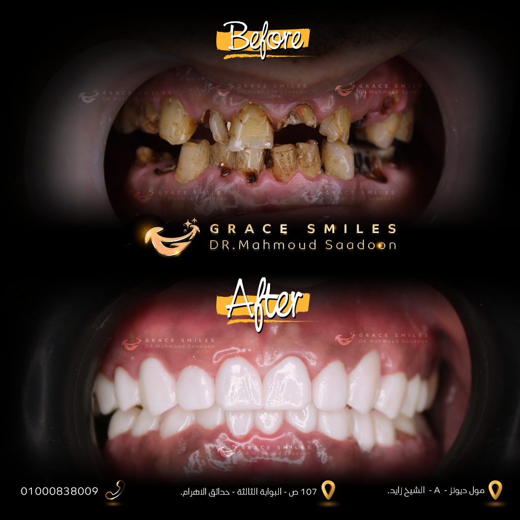 patients teeth before and after