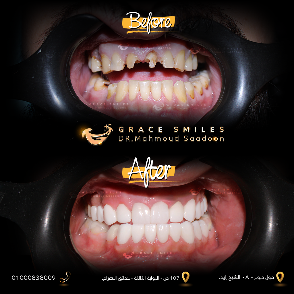 patients teeth before and after