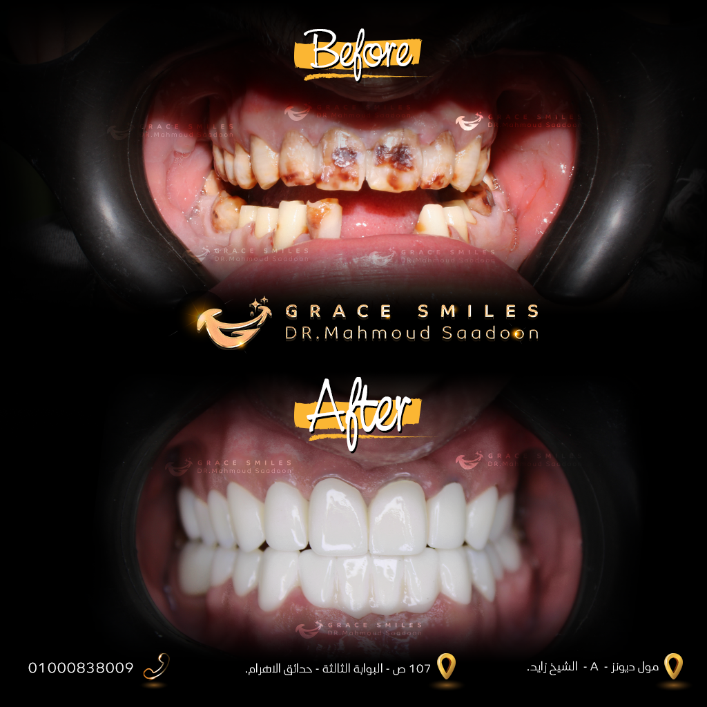 patients teeth before and after
