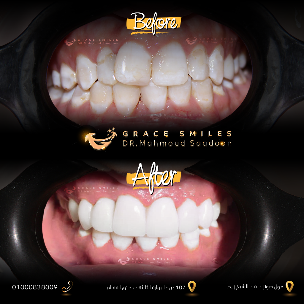 patients teeth before and after