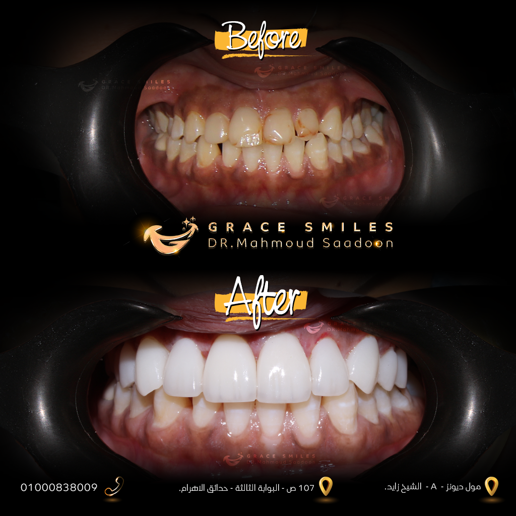 patients teeth before and after