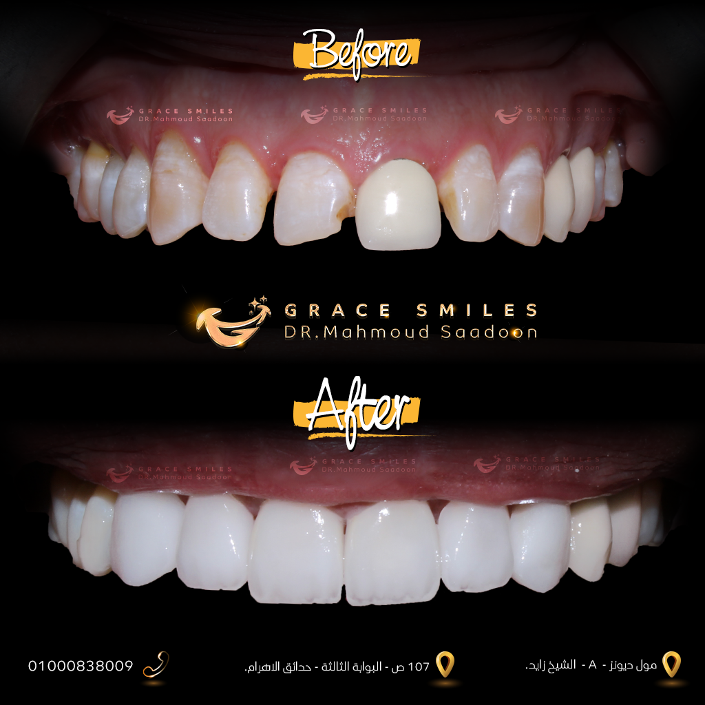 patients teeth before and after