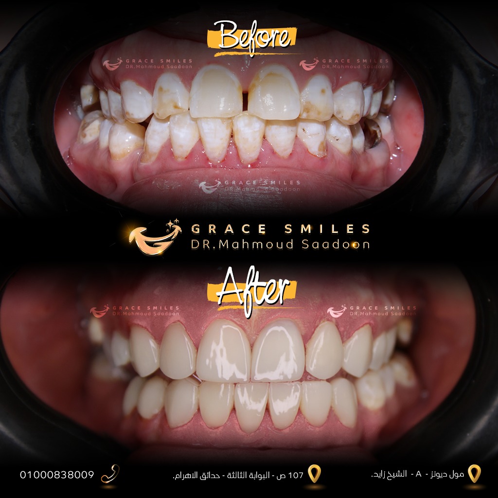 patients teeth before and after